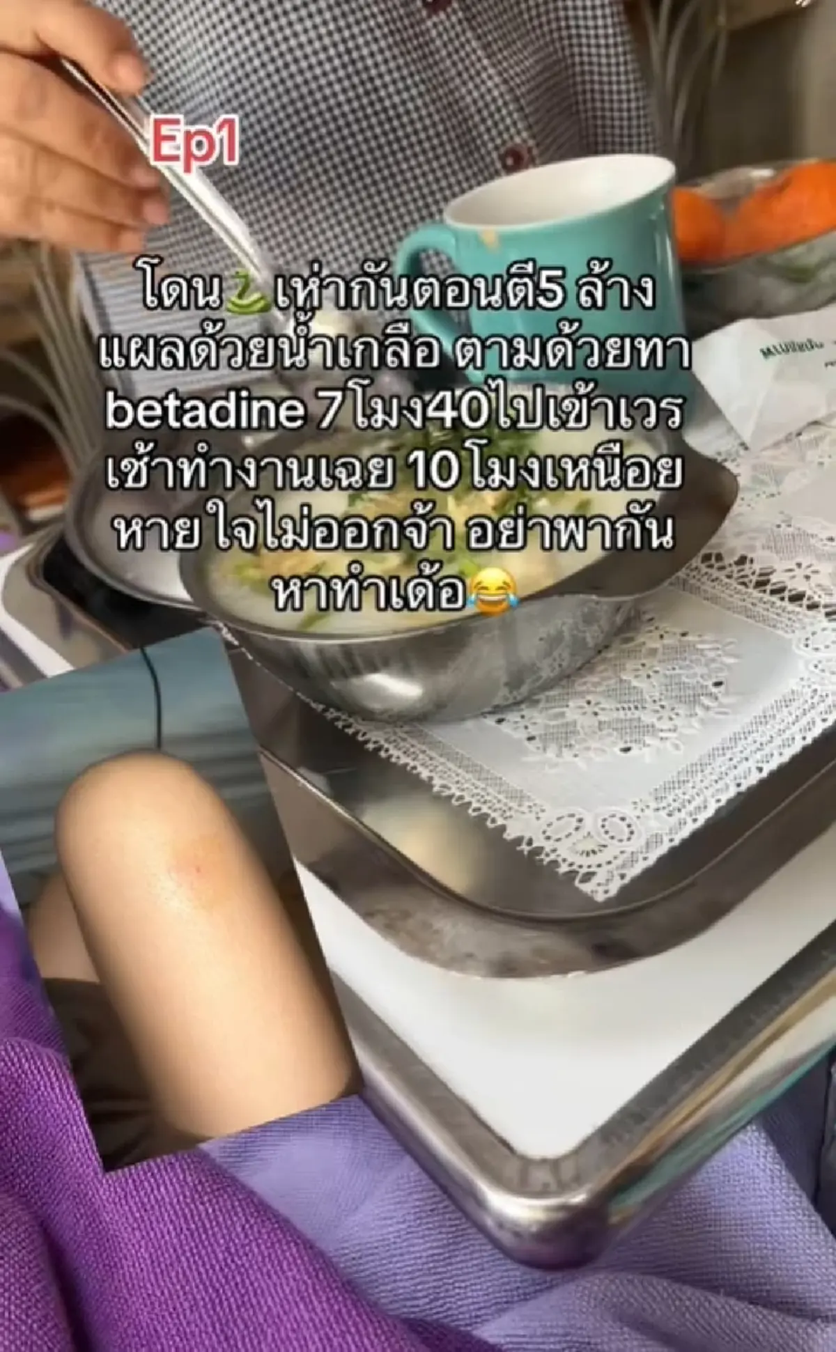 สาวถูกงูเห่ากัด ล้างแผลทาเบตาดีน แล้วเข้าเวรต่อ ภาพตัดรู้ตัวอีกทีนอน ICU