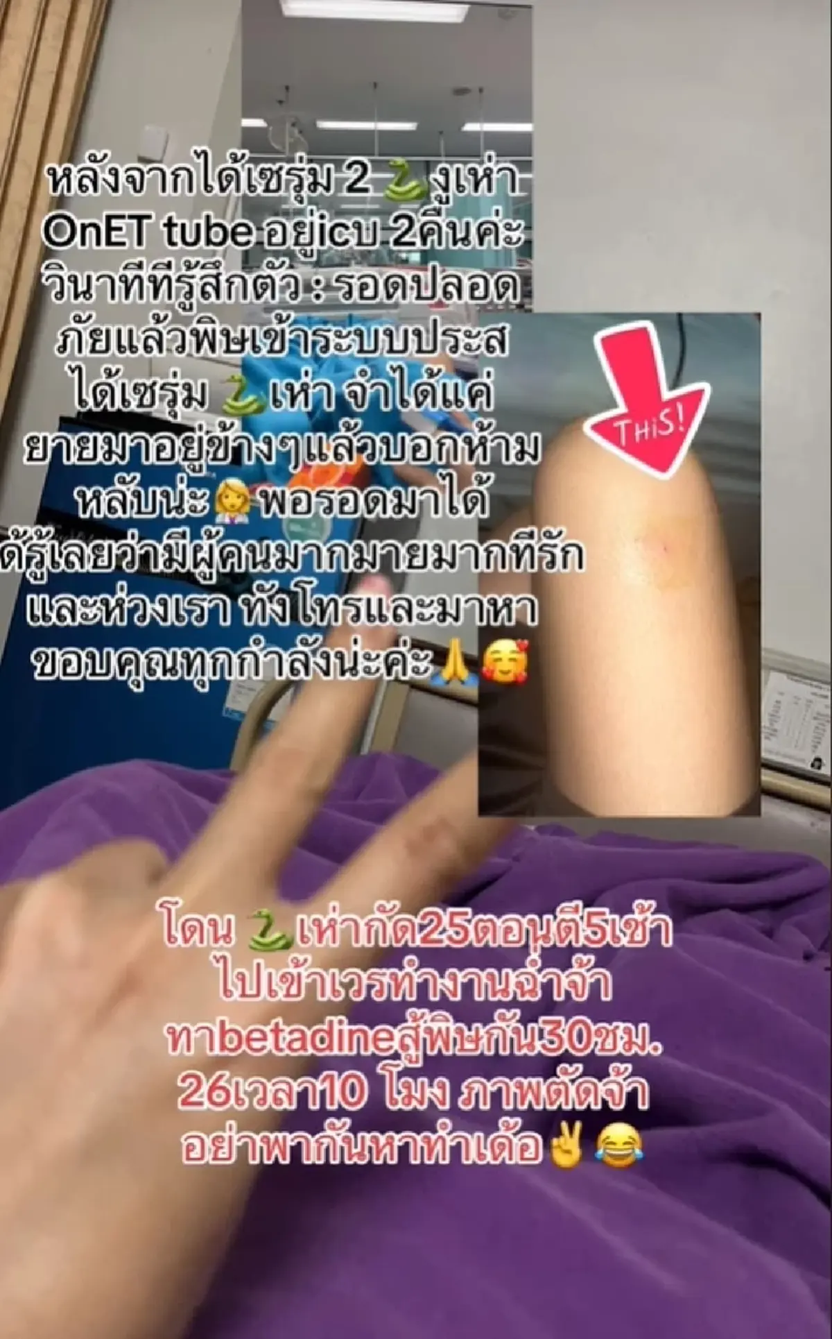 สาวถูกงูเห่ากัด ล้างแผลทาเบตาดีน แล้วเข้าเวรต่อ ภาพตัดรู้ตัวอีกทีนอน ICU