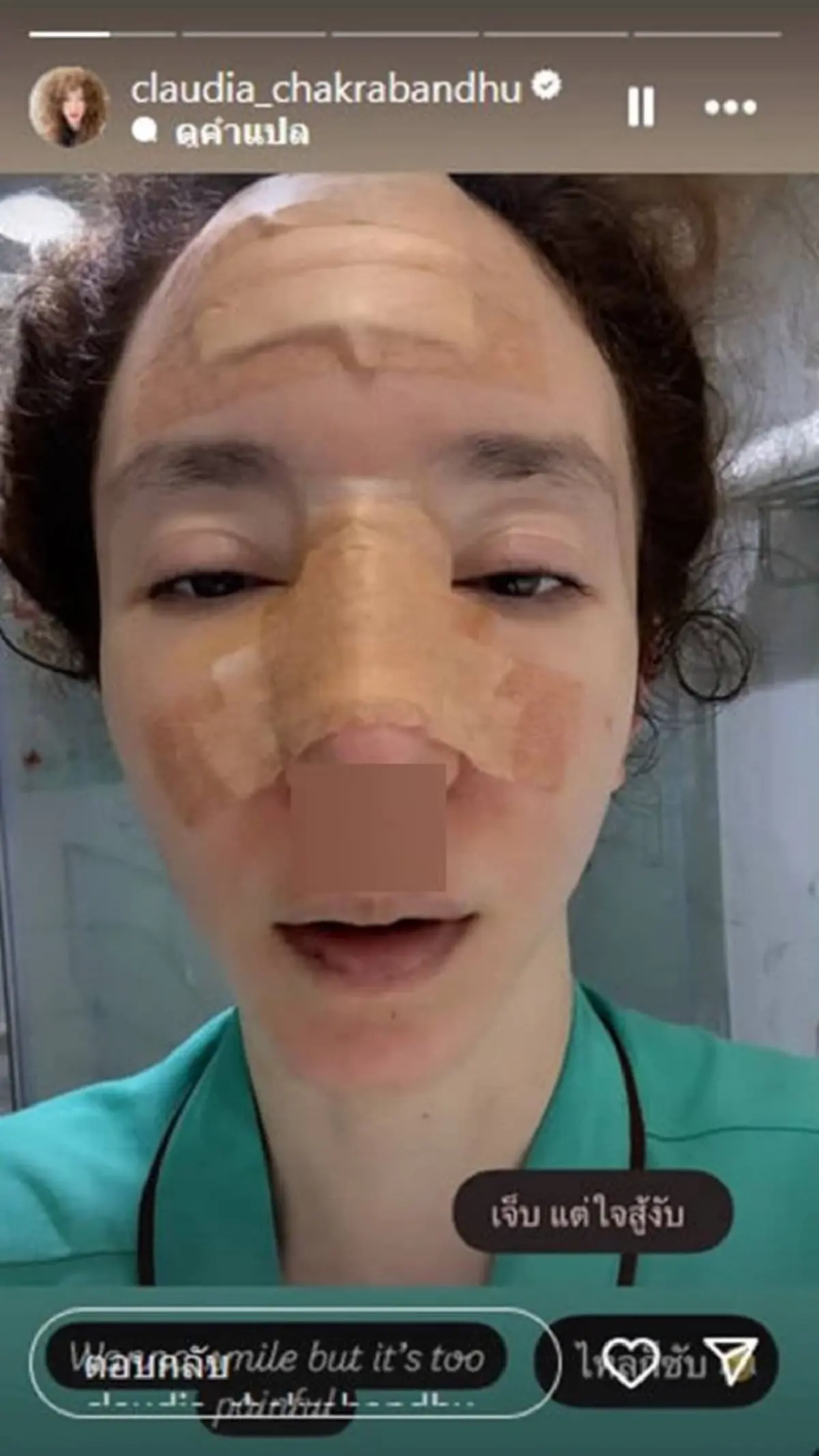 "คลาวเดีย" ยอมพูดแล้ว สาเหตุแท้จริง ล้มหัวฟาดพื้นเย็บกว่า 35 เข็ม