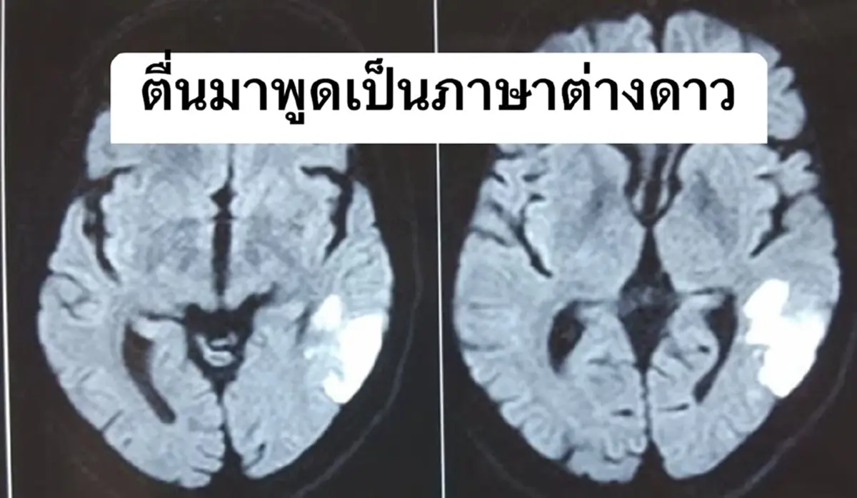 หมอดัง เผยเคสแปลก คนไข้ตื่นมาพูด ภาษาต่างดาว ที่แท้สัญญาณอันตราย