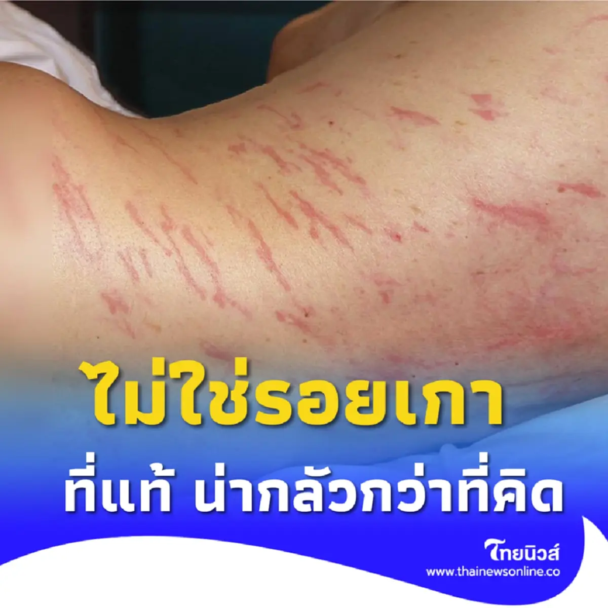 ขนลุก ชายวัย 64 ป่วยมะเร็ง มีผื่นแดงลามทั่วตัว รู้สาเหตุยิ่งตกใจ