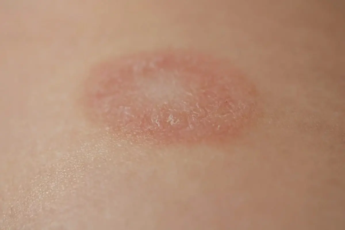 "ผื่นกลีบกุหลาบ"  โรคผิวหนังที่เกิดจากเครียดสะสม นอนน้อย