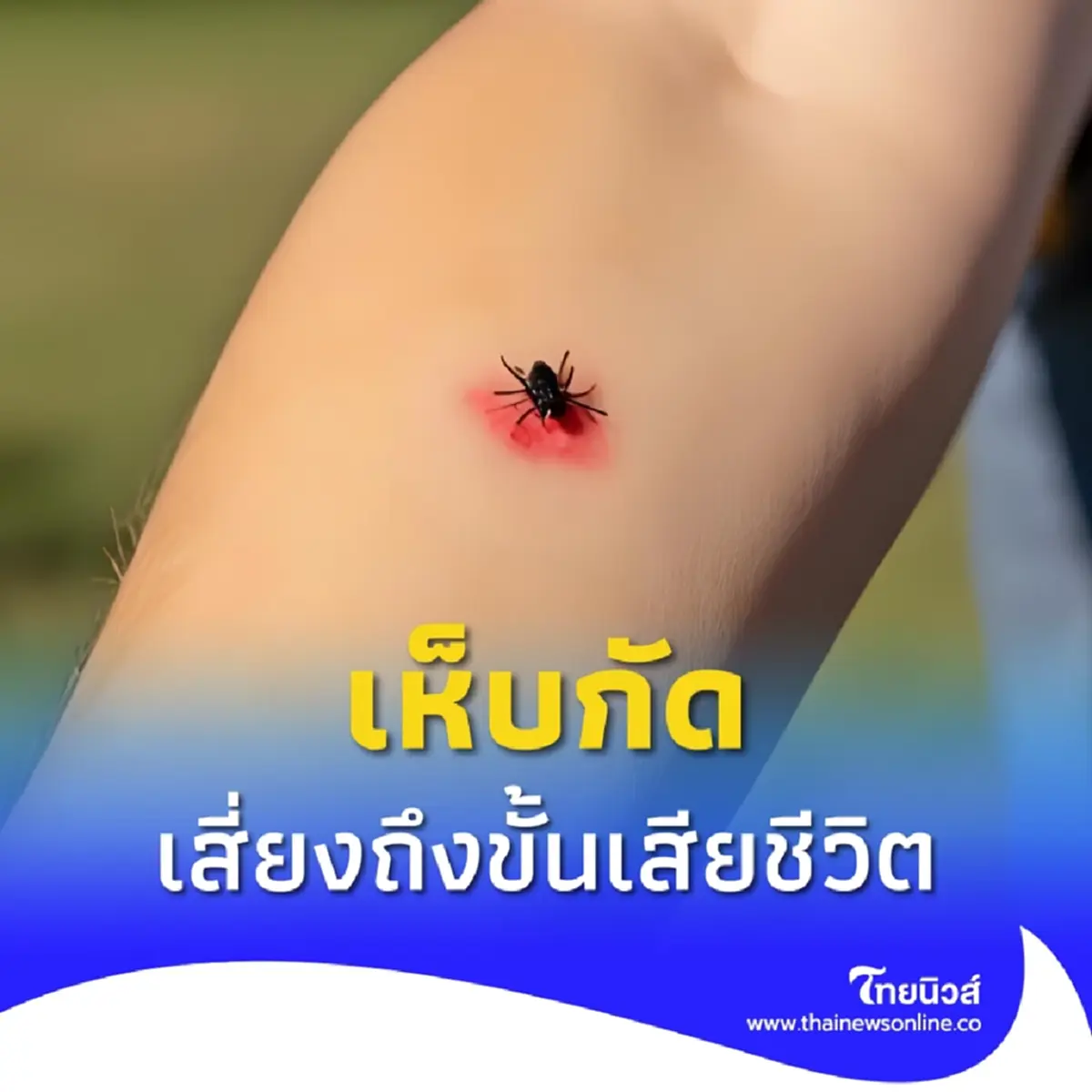 ของจริง โดน เห็บกัด เสี่ยงถึงขั้นเสียชีวิตจากเชื้อไวรัส
