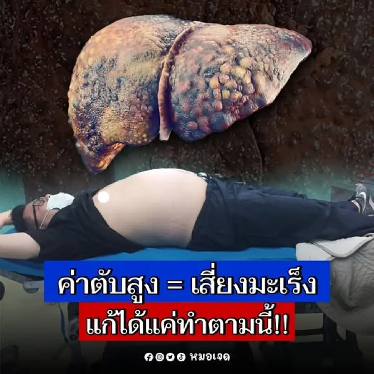 เปิดวิธีแก้ ค่าตับสูง หมอเผยเอง รีบทำก่อน มะเร็งตับ ถามหา 