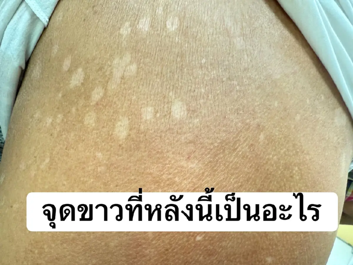 \"จุดขาวเต็มหลัง\"ที่แท้ไม่ใช่โรค หมอแชร์เคสชายวัย70 เผยสาเหตุ