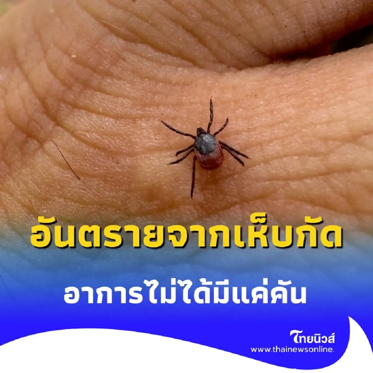 เปิดอาการ คนถูกเห็บกัด มีอาการอย่างไร รักษาแบบไหน มีคำตอบ