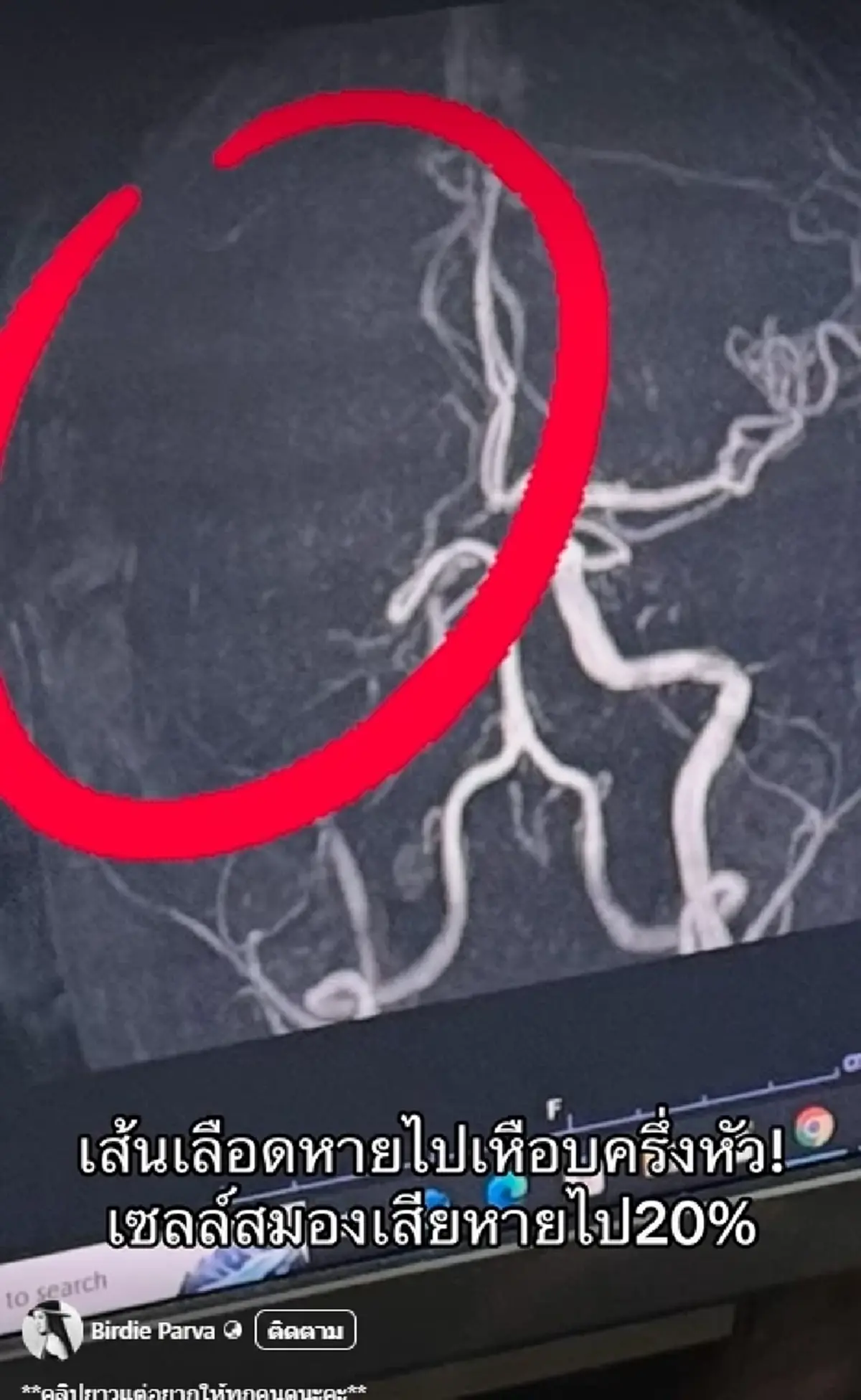 สาวเฉียดตาย พักผ่อนน้อย ใช้ชีวิตหนัก Strokeมาเยือน 1ในแสนที่รอด