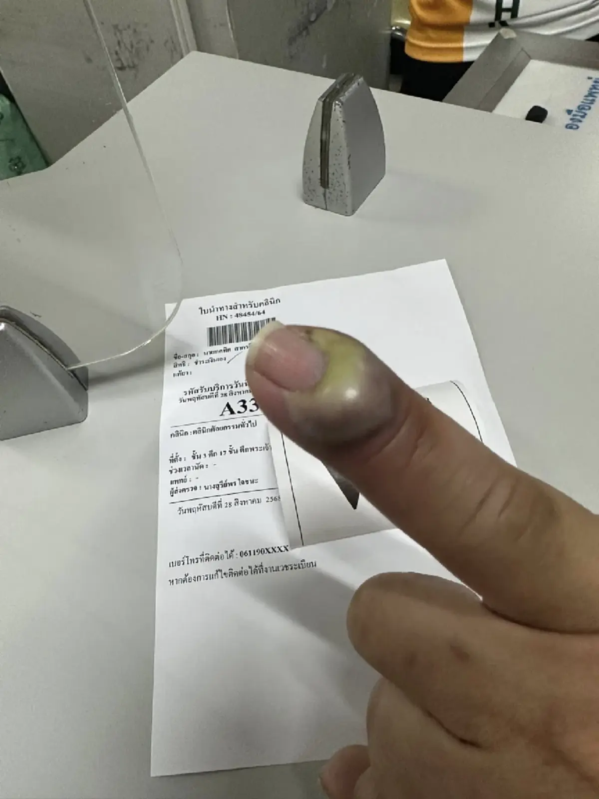 หนุ่มหวิดโดนตัดนิ้ว แผลเล็ก ๆ จากแมวข่วน เตือนอย่าชะล่าใจ