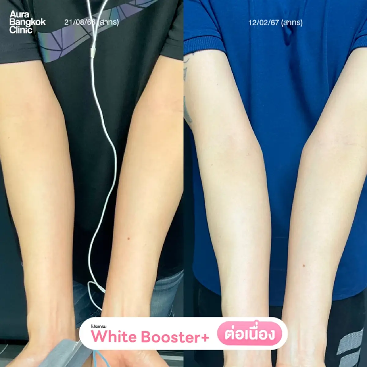 ฉีดวิตามินผิวคืออะไร? ปลอดภัยไหม? ต้องฉีดกี่ครั้งถึงจะเห็นผล