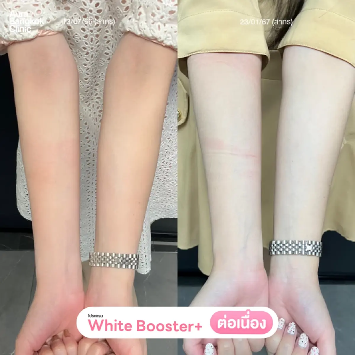 ฉีดวิตามินผิวคืออะไร? ปลอดภัยไหม? ต้องฉีดกี่ครั้งถึงจะเห็นผล