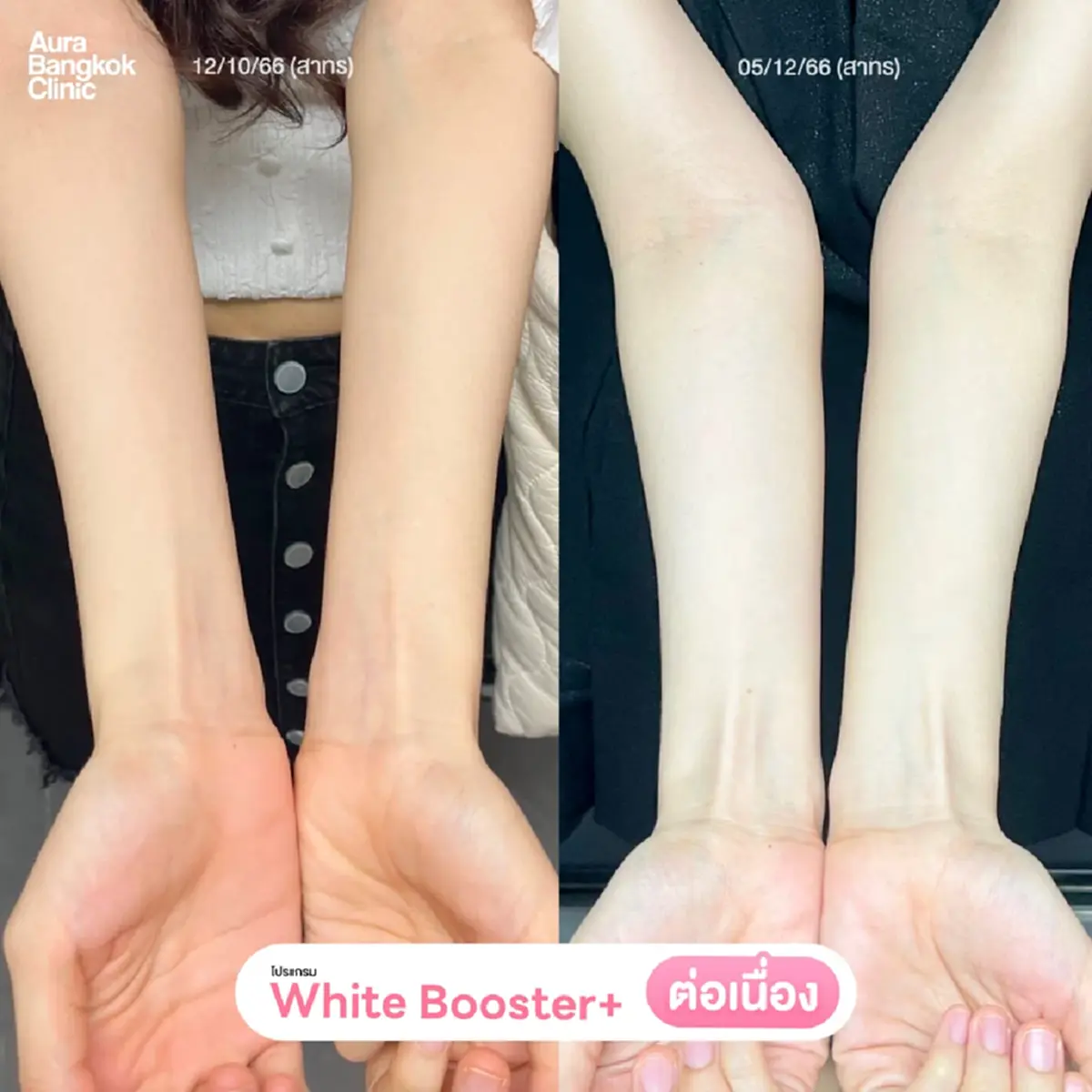 ฉีดวิตามินผิวคืออะไร? ปลอดภัยไหม? ต้องฉีดกี่ครั้งถึงจะเห็นผล