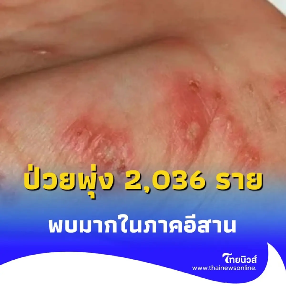 อย่ามองข้าม โรคไข้ดิน คร่าชีวิตไปแล้ว 92 ราย เสี่ยงสูงในภาคอีสาน