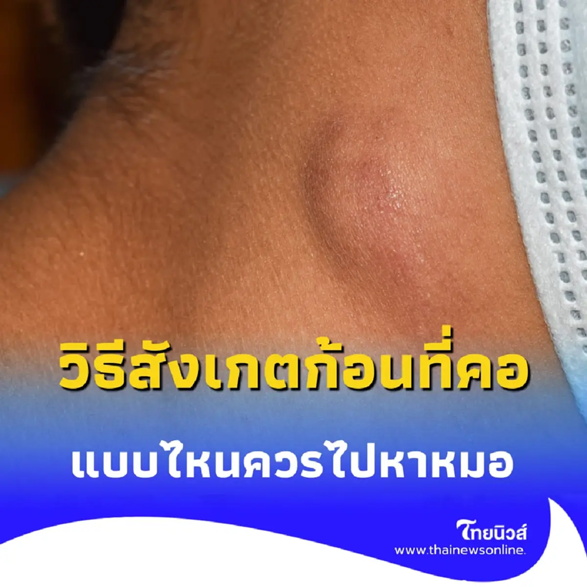 วิธีสังเกตก้อนที่คอ แบบไหนควรไปหาหมอโดยเร็วที่สุด วันนี้มีคำตอบ