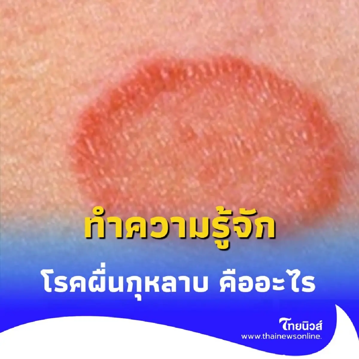 ทำความรู้จัก โรคผื่นกุหลาบ คืออะไร สัญญาณเตือนที่คนท้องต้องรู้