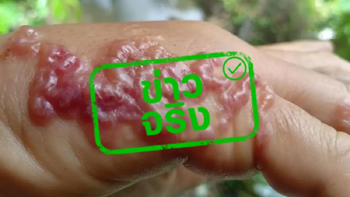 อันตรายใกล้ตัว แค่เดินเท้าเปล่าบนดินก็เสี่ยง พยาธิไชจากสัตว์เลี้ยงที่คุณรัก