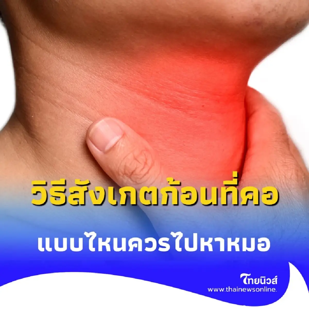 วิธีสังเกตก้อนที่คอ แบบไหนควรไปหาหมอโดยเร็วที่สุด วันนี้มีคำตอบ