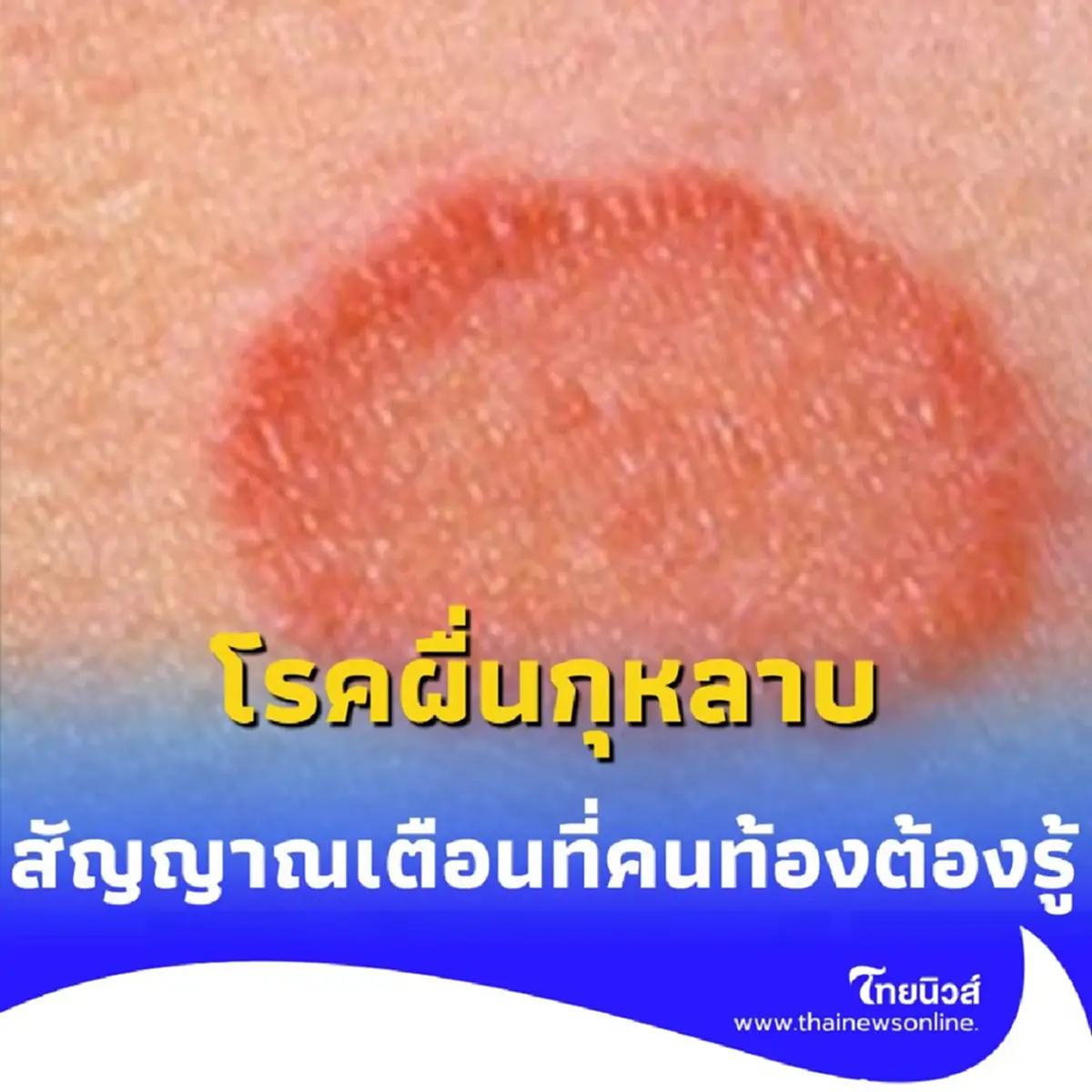 ทำความรู้จัก โรคผื่นกุหลาบ คืออะไร สัญญาณเตือนที่คนท้องต้องรู้