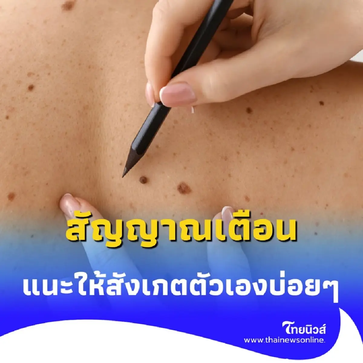 หมอเตือน 5 สัญญาณอันตรายของ ไฝ ที่อาจกลายเป็นมะเร็งผิวหนัง