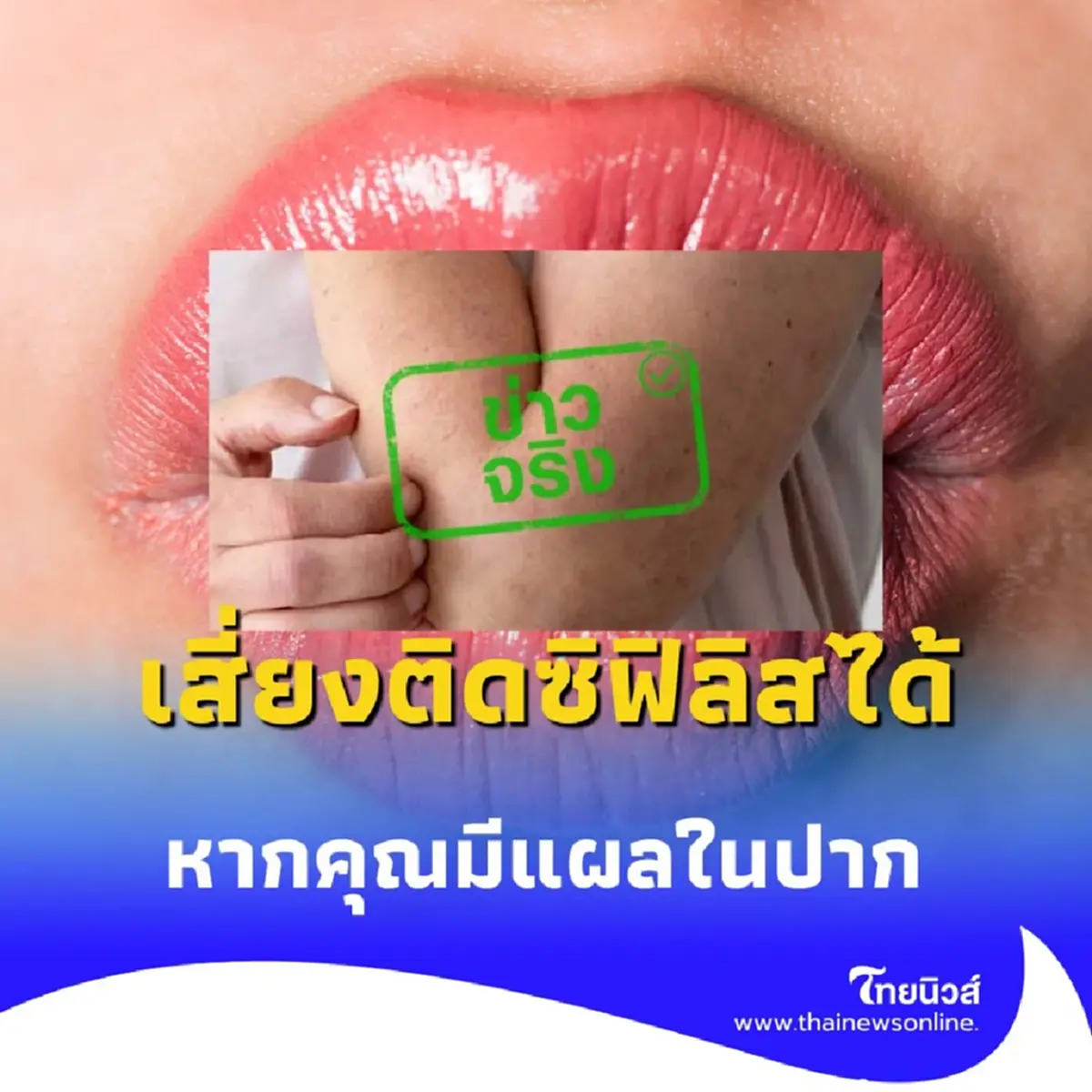 ระวัง การจูบอาจเสี่ยงติด ซิฟิลิส ได้หากคุณมีแผลในปาก
