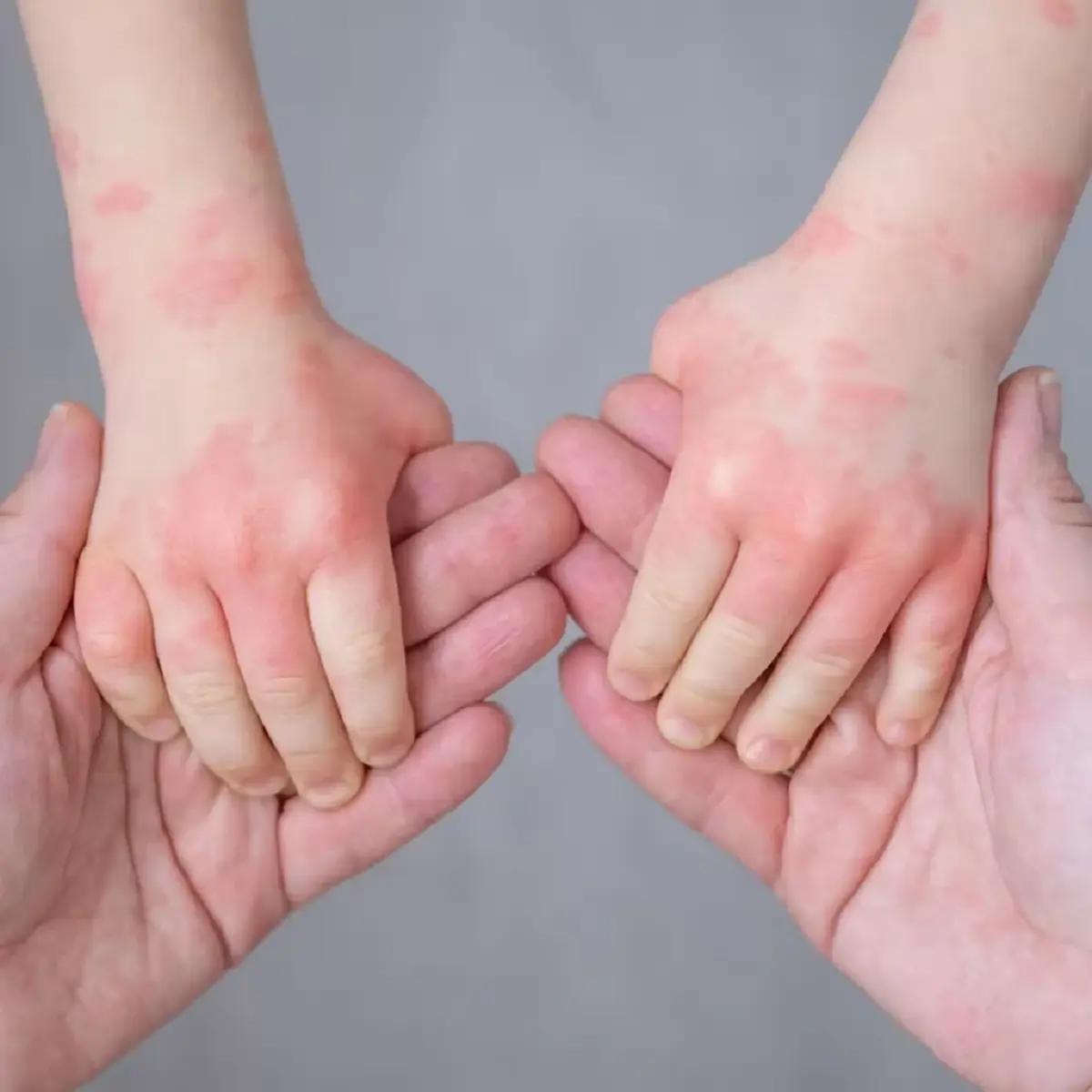 โรคมือ เท้า ปาก ในเด็ก อันตรายกว่าที่คิด รู้เท่าทันก่อนสายเกินไป