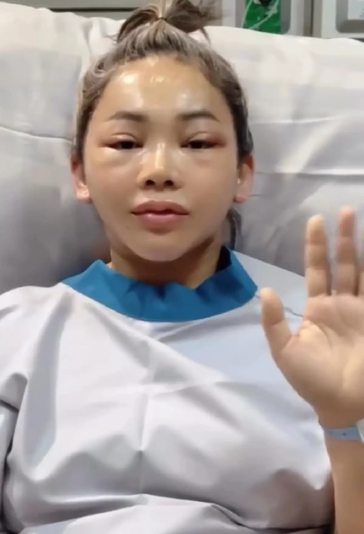 หน้าวีขั้นสุด ตั๊กแตน ชลดา ทำศัลยกรรมครั้งใหญ่ หน้าเด็กลงมาก