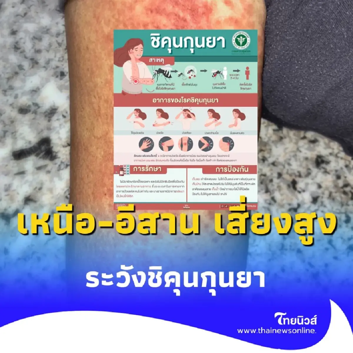 กรมควบคุมโรคชี้ 10 จังหวัด เหนือ-อีสาน เสี่ยงสูง ระวังชิคุนกุนยา