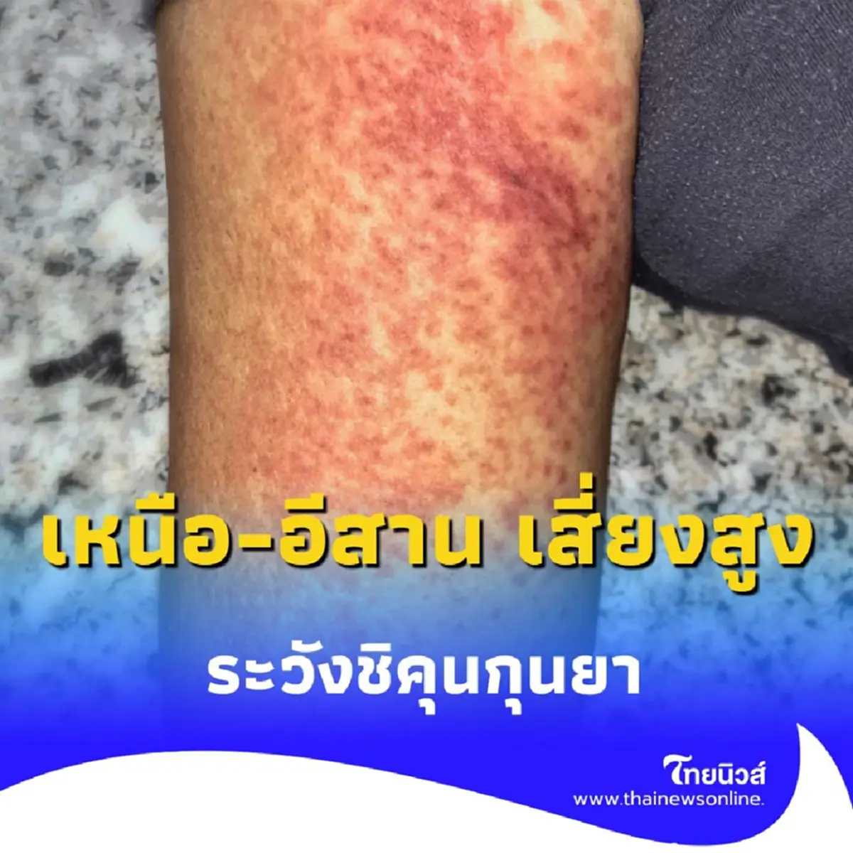 กรมควบคุมโรคชี้ 10 จังหวัด เหนือ-อีสาน เสี่ยงสูง ระวังชิคุนกุนยา