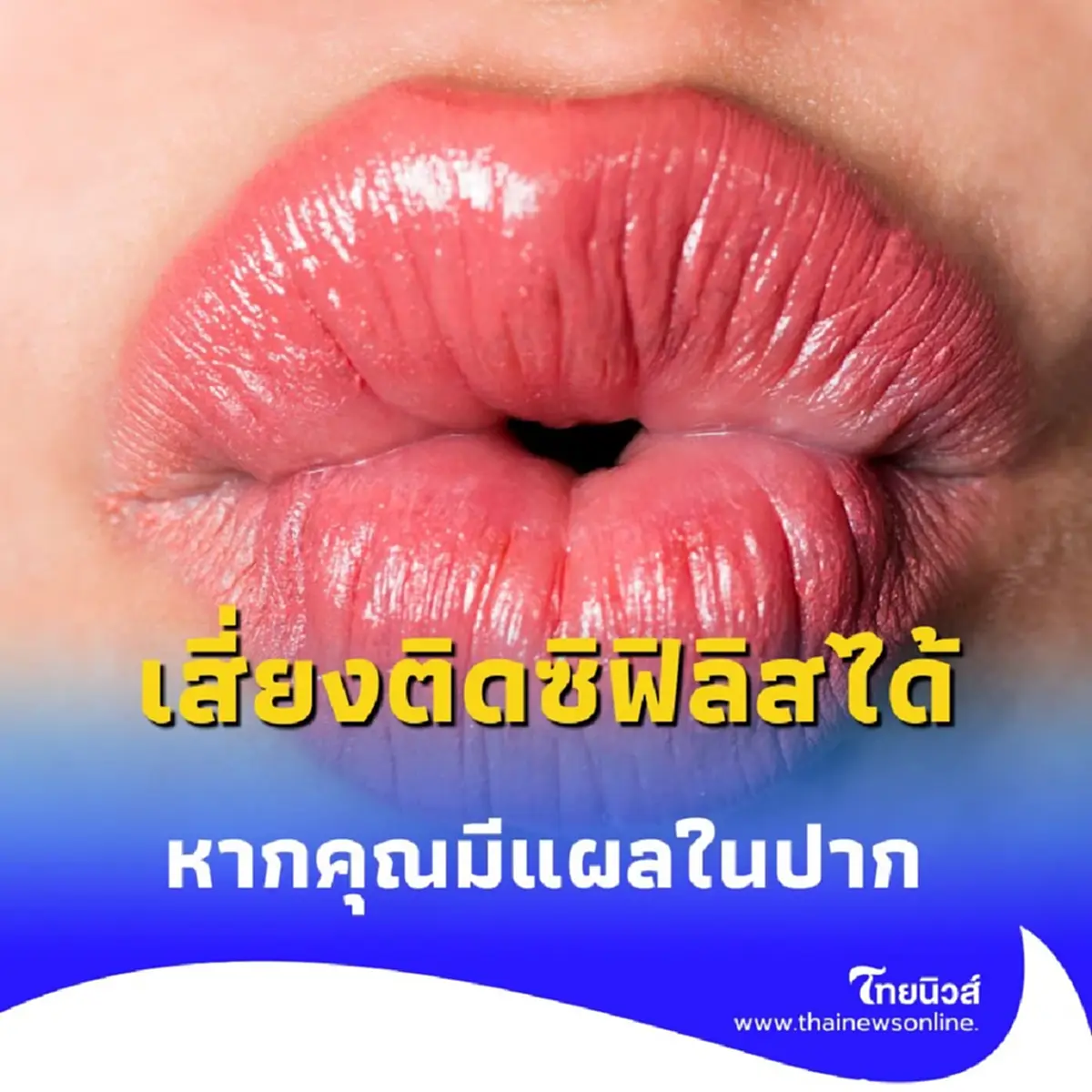 ระวัง การจูบอาจเสี่ยงติด ซิฟิลิส ได้หากคุณมีแผลในปาก