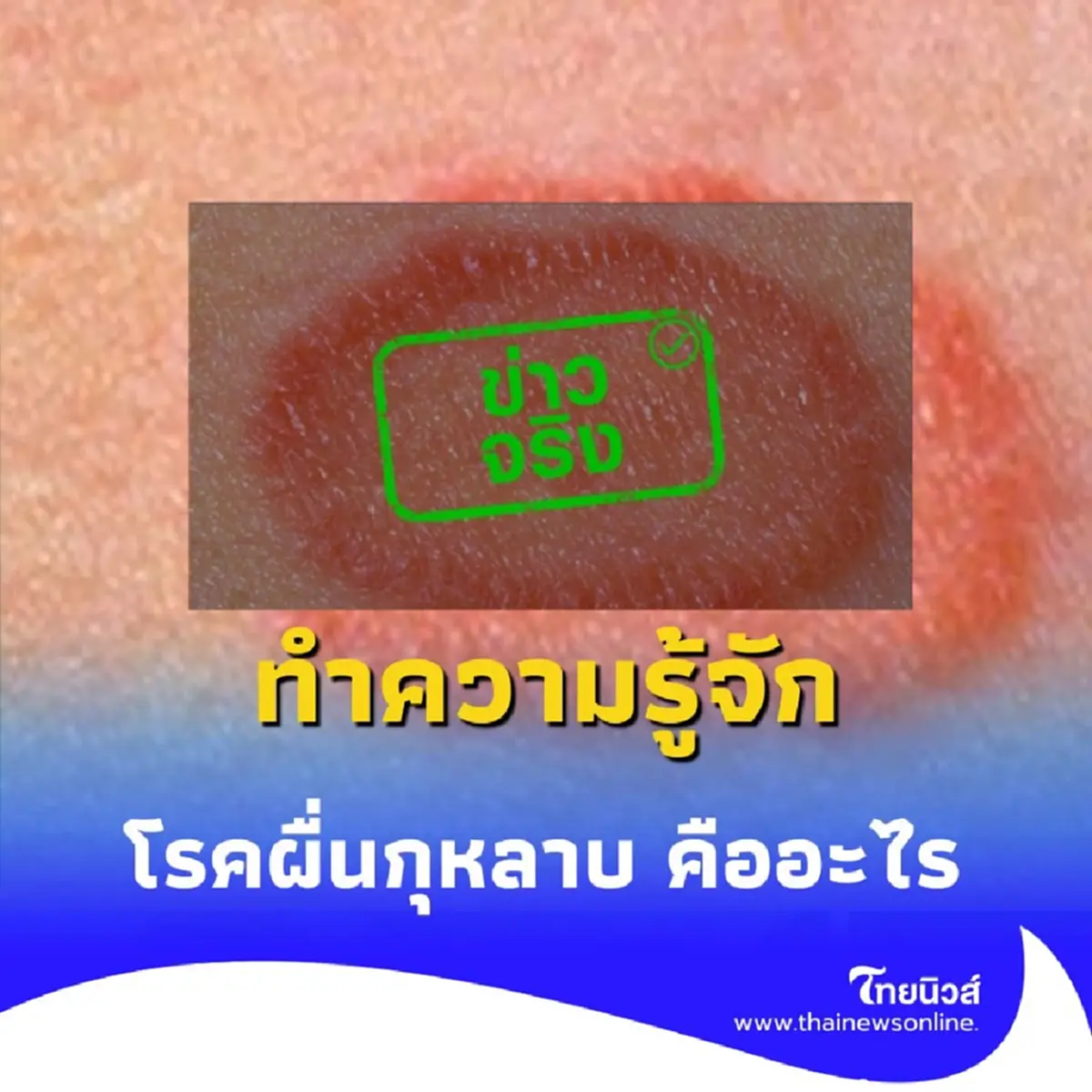 ทำความรู้จัก โรคผื่นกุหลาบ คืออะไร สัญญาณเตือนที่คนท้องต้องรู้