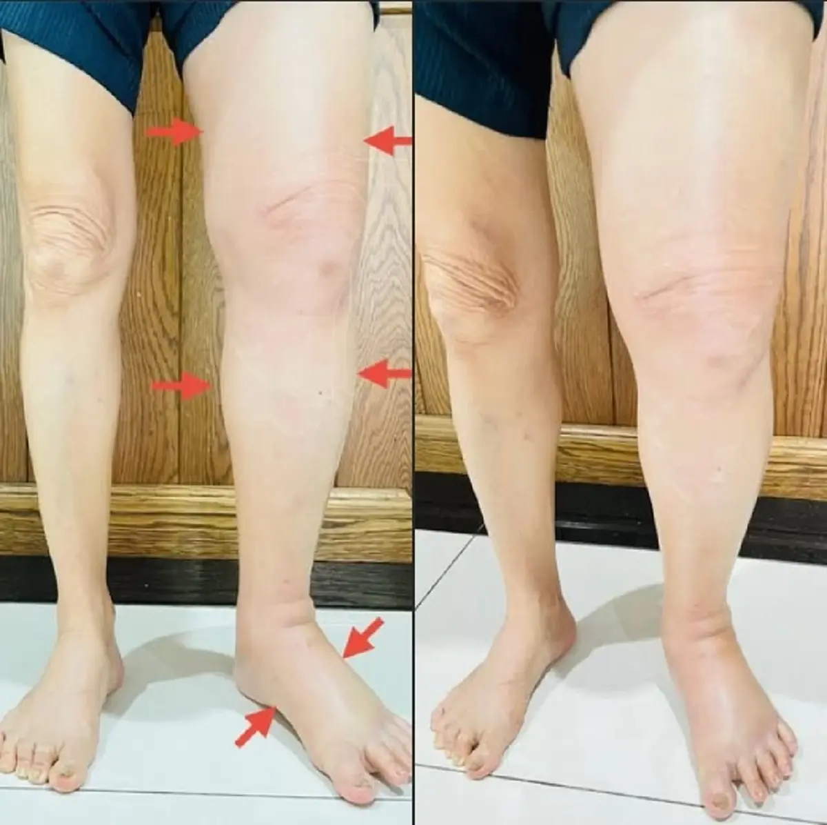 หมอมนูญ เปิดเคส ชายขาซ้ายบวมทั้งขา ก่อนเจอต้นตอ สุดอันตราย 