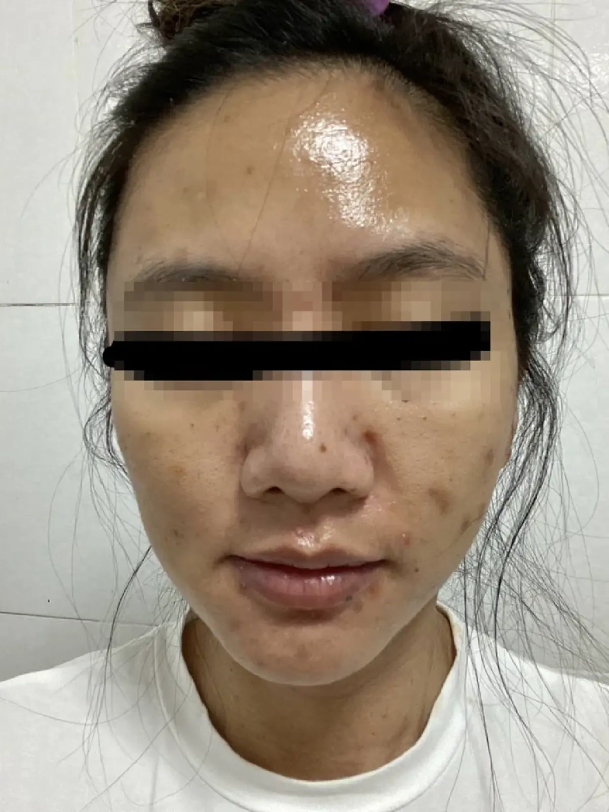 อดีตผู้ประกาศดัง เจอพิษหมอเก๊ ฉีดยาเถื่อนให้จนหน้าพัง