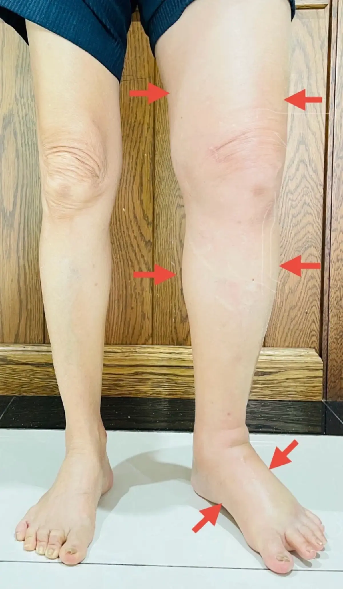 ชายขาซ้ายบวมถึงเท้า หมอเผยสาเหตุ เตือนรีบรักษา อันตรายถึงชีวิต