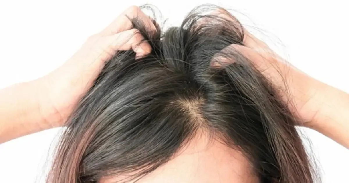 เชื้อราบนหนังศีรษะ อย่ามองข้าม เสี่ยงผมร่วง-คันเรื้อรัง