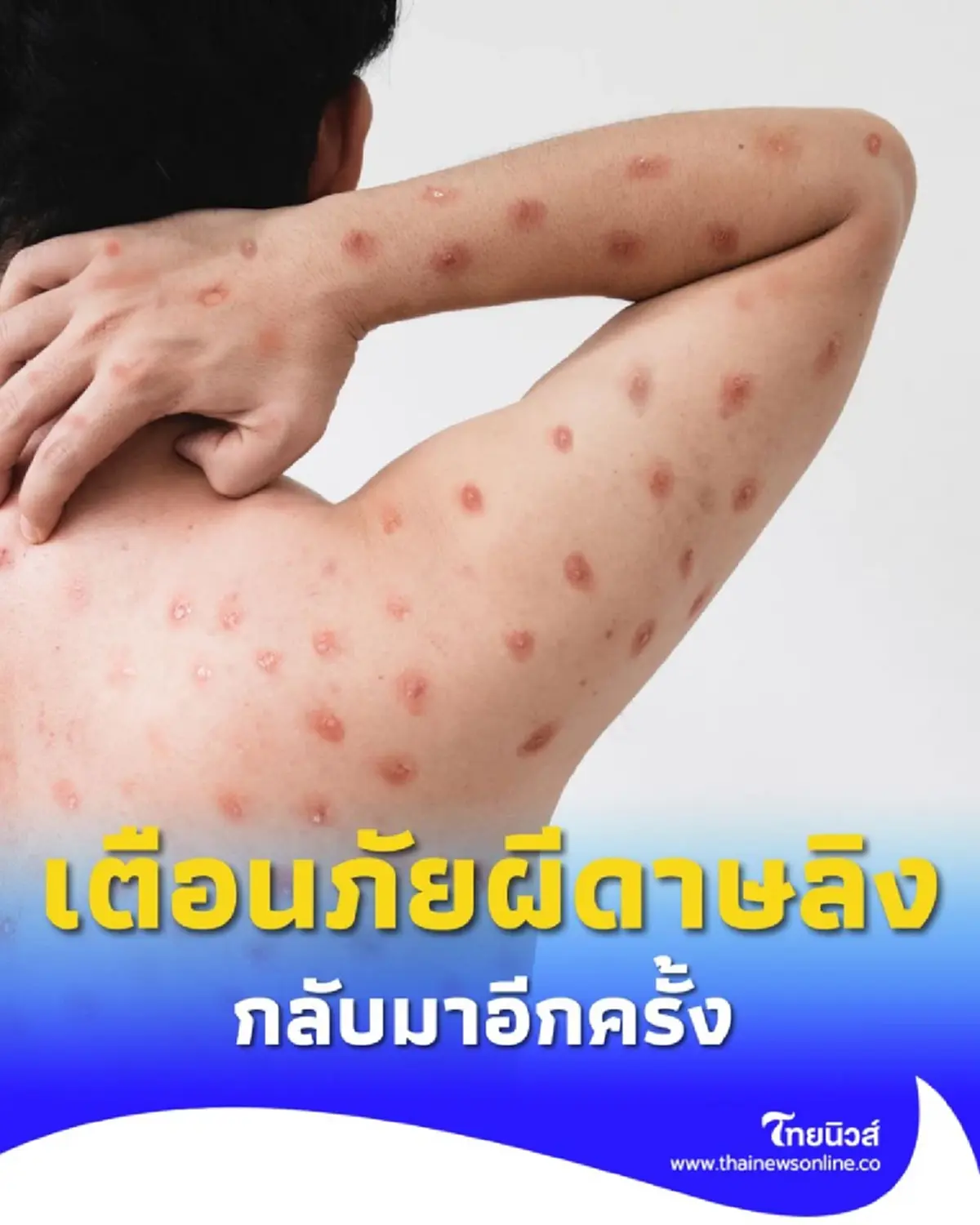 เตือนภัย โรคฝีดาษวานรกลับมาระบาดในไทยอีกครั้ง พร้อมวิธีป้องกันที่ต้องรู้