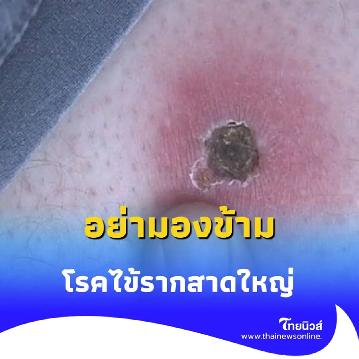 ไข้รากสาดใหญ่ โรคร้ายที่เริ่มต้นจากรอยคล้ายบุหรี่จี้ และอาจอันตรายถึงชีวิต