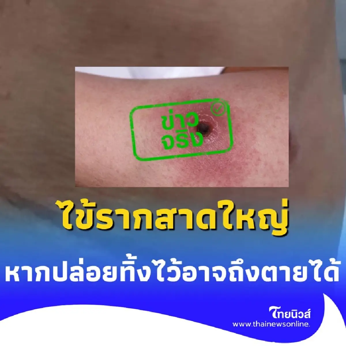 ไข้รากสาดใหญ่ โรคร้ายที่เริ่มต้นจากรอยคล้ายบุหรี่จี้ และอาจอันตรายถึงชีวิต