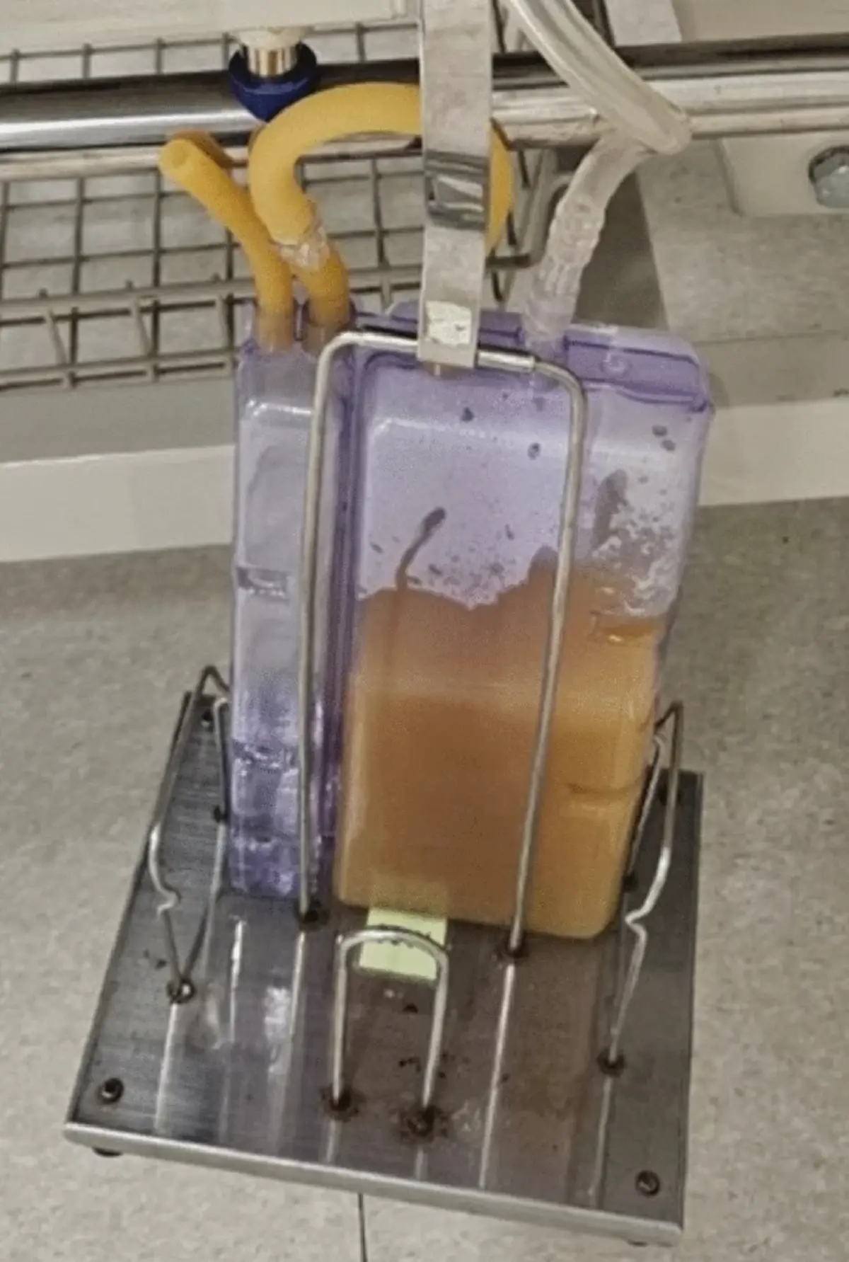 เตือนใครชอบกิน ปูดิบ กุ้งดิบ หลัง สาว 14 เจอหนองในช่องเยื่อหุ้มปอด