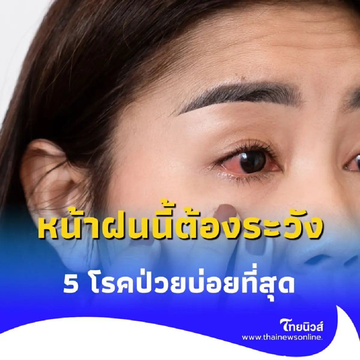 เตือนระวังให้ดี 5 โรคยอดฮิตที่ต้องระวังในช่วงหน้าฝนนี้