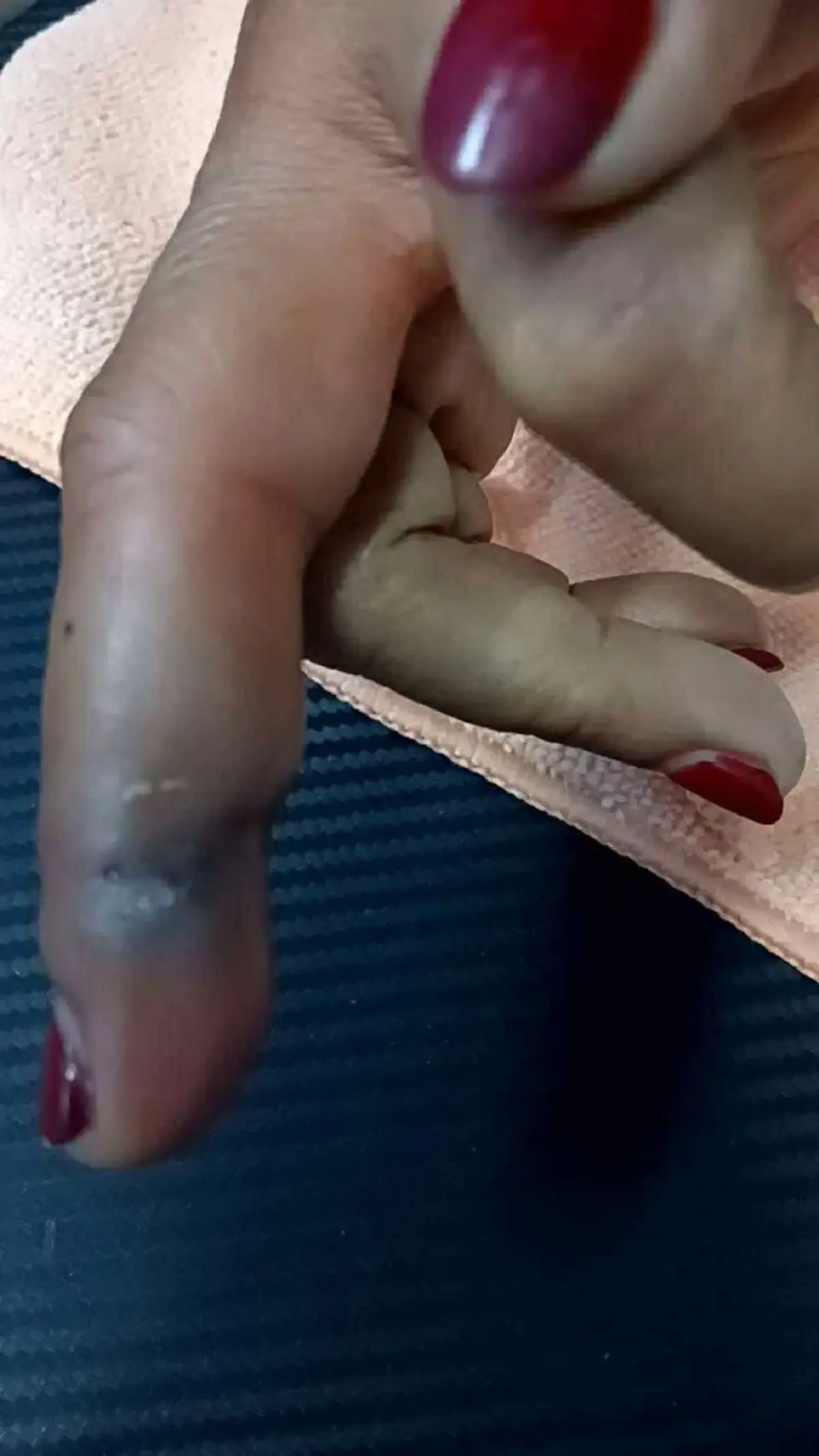 หญิงทำกับข้าว ถูกเปลือกกุ้งทิ่มมือ สุดท้ายติดเชื้อรุนแรง