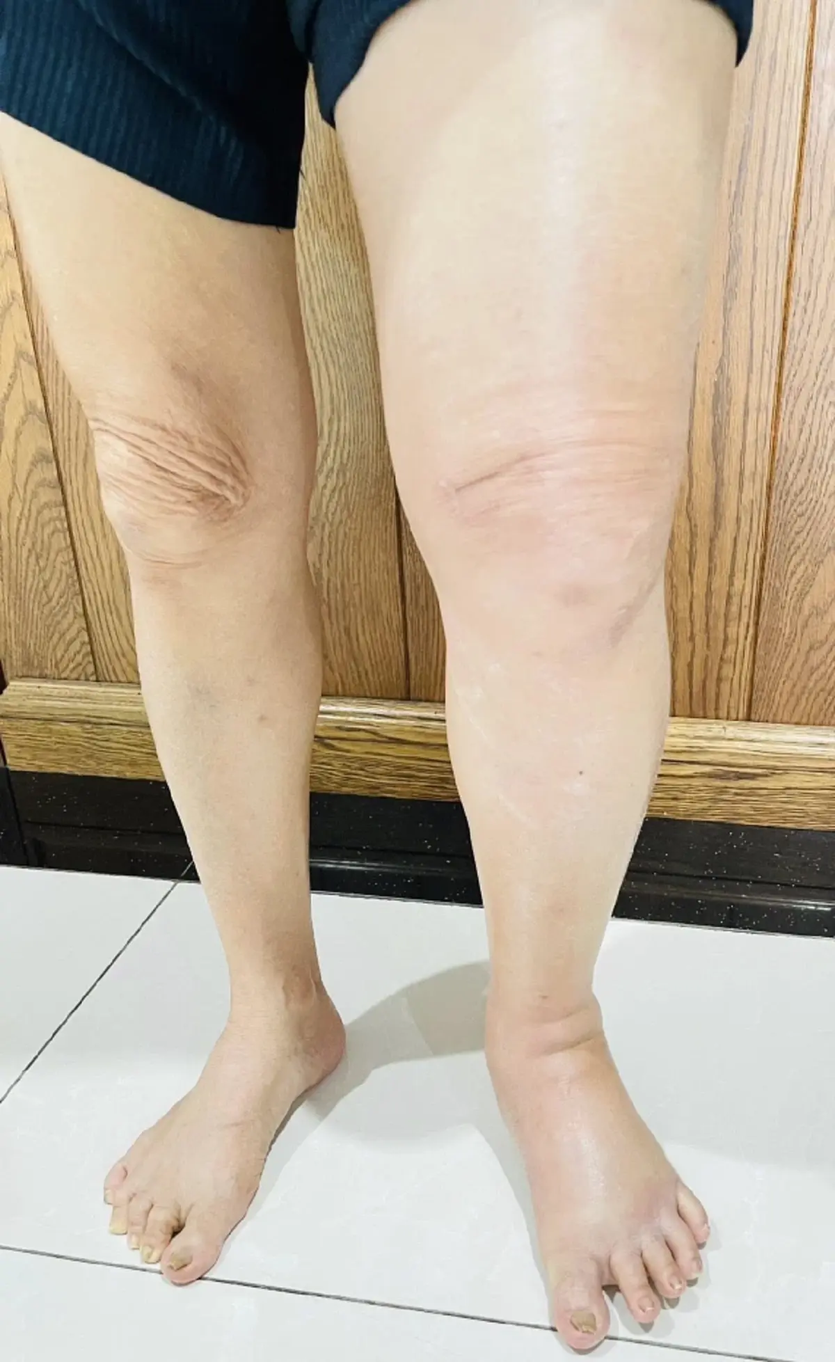 ชายขาซ้ายบวมถึงเท้า หมอเผยสาเหตุ เตือนรีบรักษา อันตรายถึงชีวิต