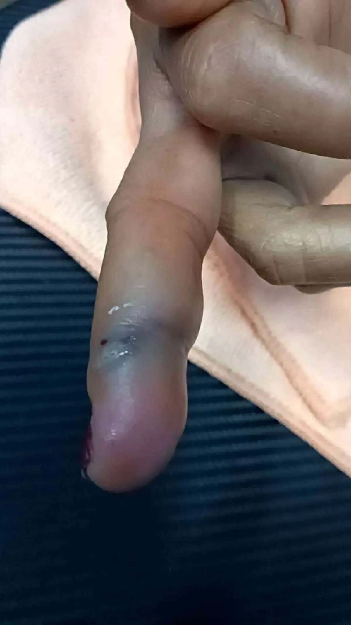 หญิงทำกับข้าว ถูกเปลือกกุ้งทิ่มมือ สุดท้ายติดเชื้อรุนแรง