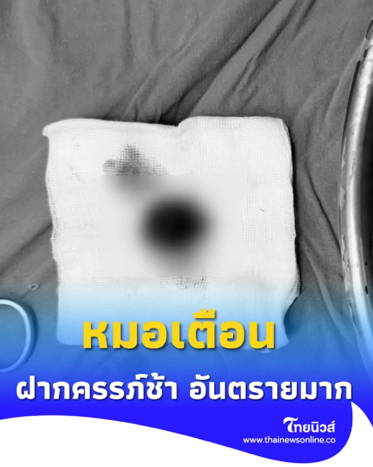 อย่าชะล่าใจ ฝากครรภ์ช้า เสี่ยง "ท้องนอกมดลูก" อันตรายถึงชีวิต