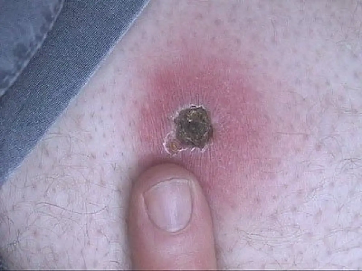 สายแคมป์ต้องระวัง! “ไข้รากสาด” ระบาดในช่วงหน้าฝนอย่าประมาทเวลาเข้าป่า