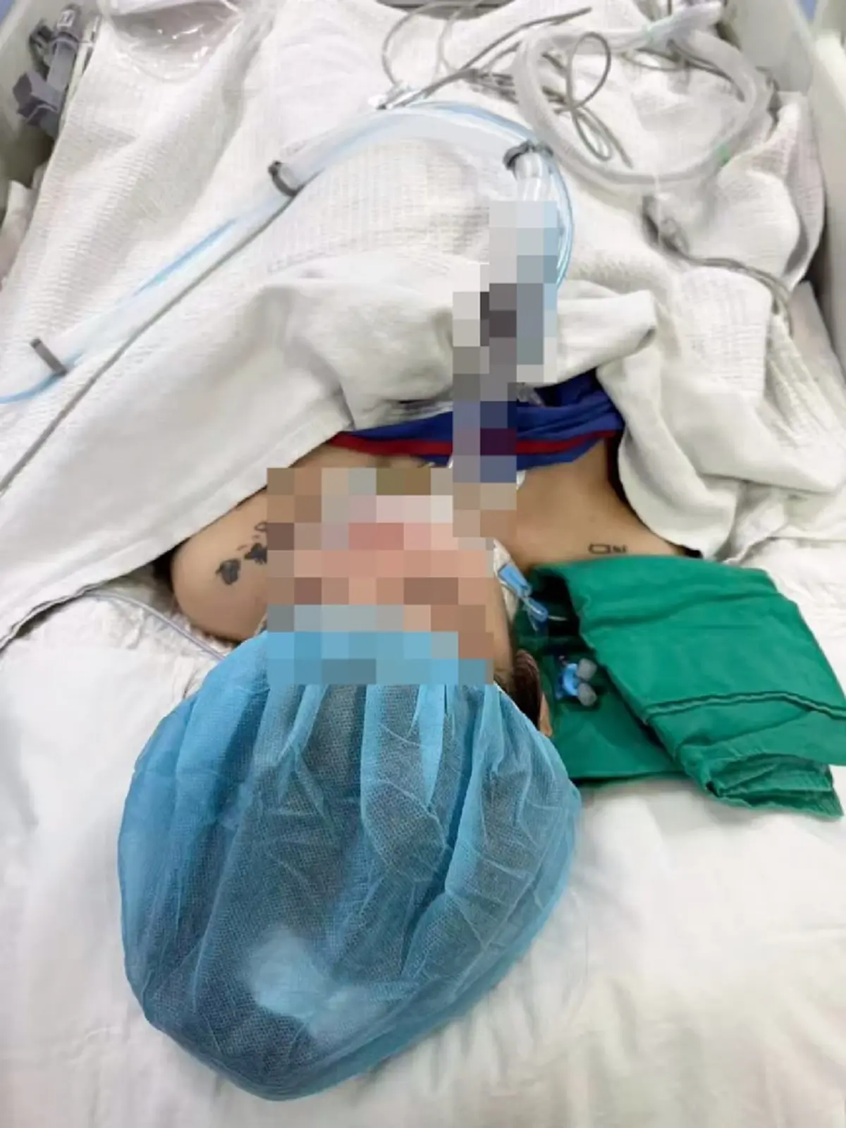 เตือนอุทาหรณ์ชั้นดี ตัดปอดทิ้ง40% สายดูดพอต ดูไว้เป็นตัวอย่าง 