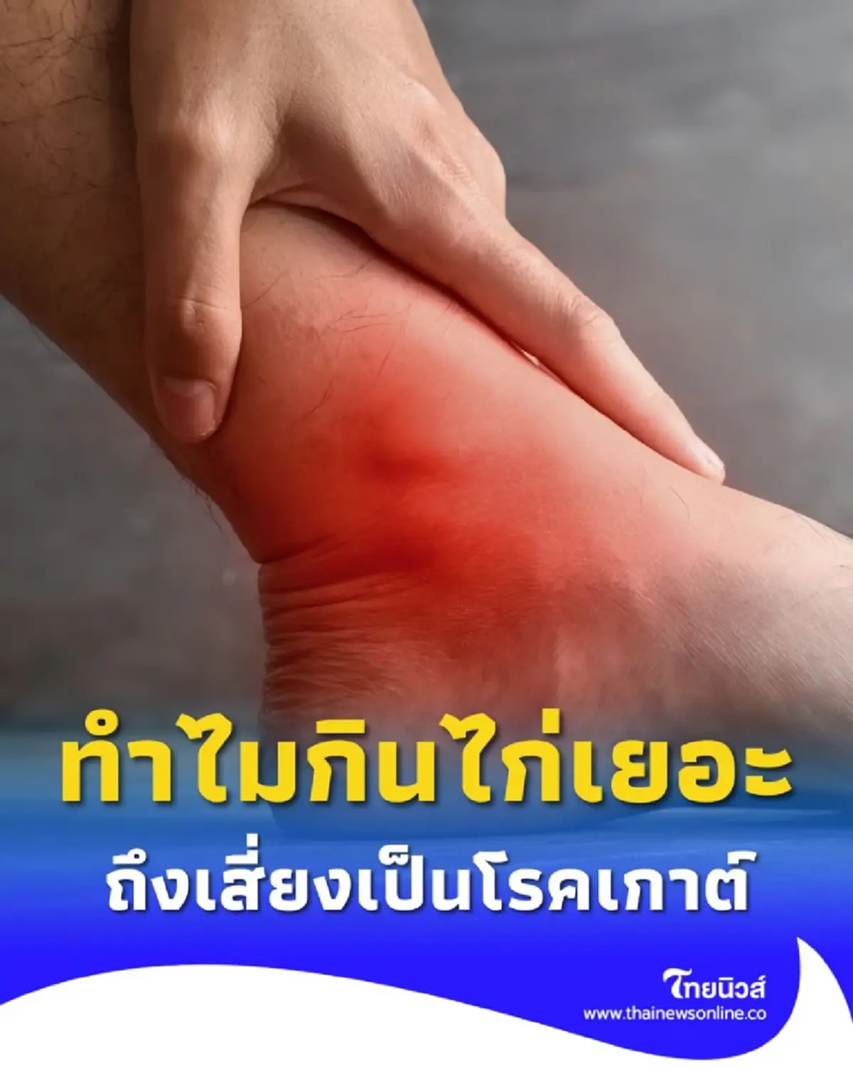 ไขข้อสงสัย ทำไม &quot;กินไก่เยอะ&quot; ถึงเสี่ยงเป็นโรคเกาต์ วันนี้มีคำตอบ