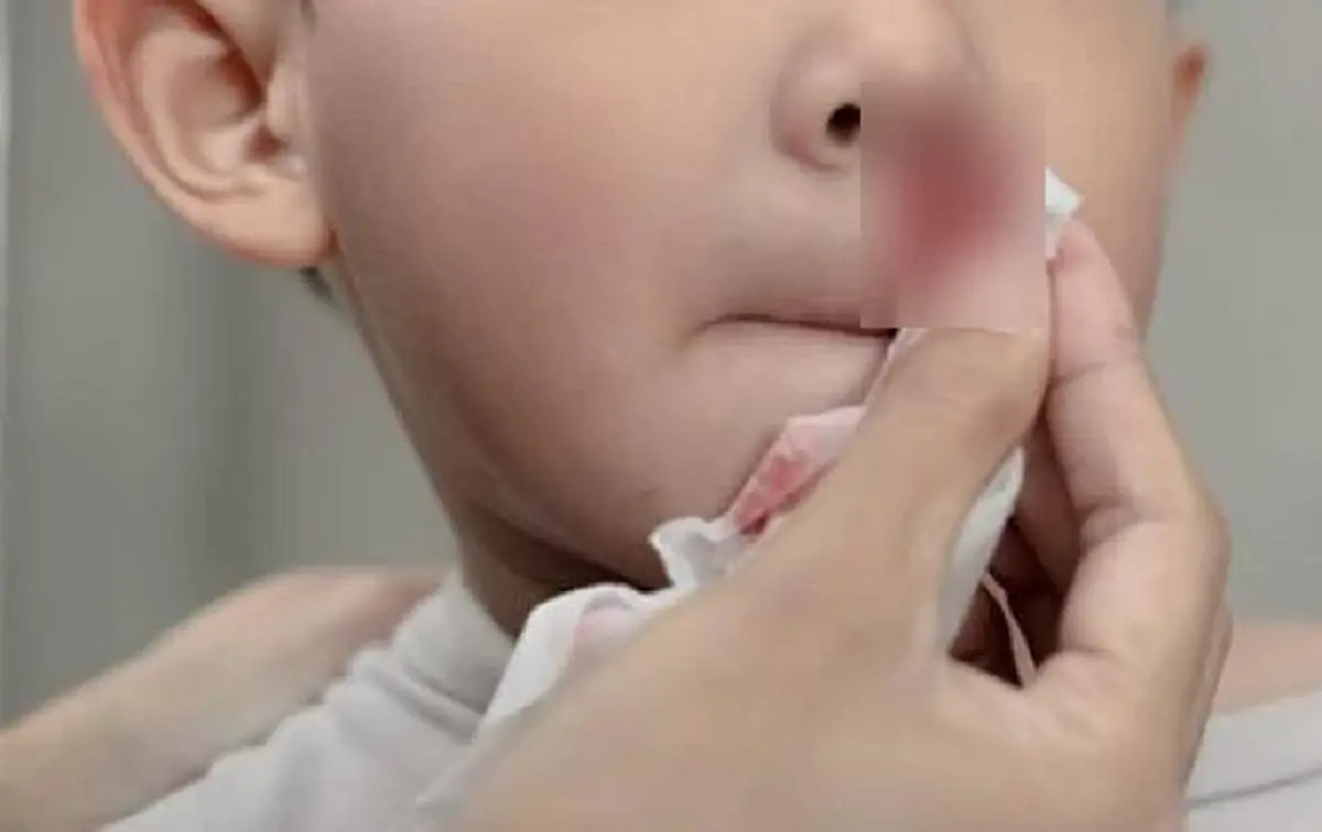 เตือนพ่อแม่ เคสเด็ก7ขวบ เลือดกำเดาไหลไม่หยุด ซักประวัติเจอเต็ม ๆ