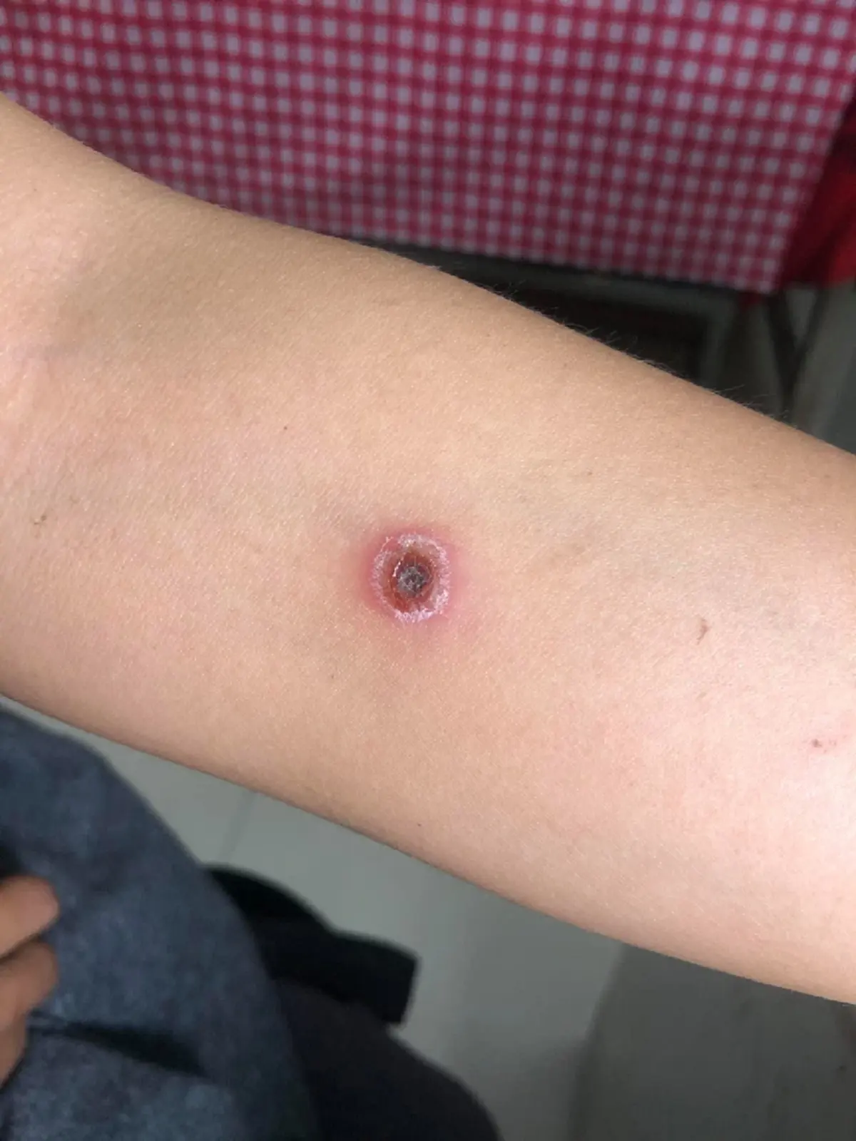 สายแคมป์ต้องระวัง! “ไข้รากสาด” ระบาดในช่วงหน้าฝนอย่าประมาทเวลาเข้าป่า