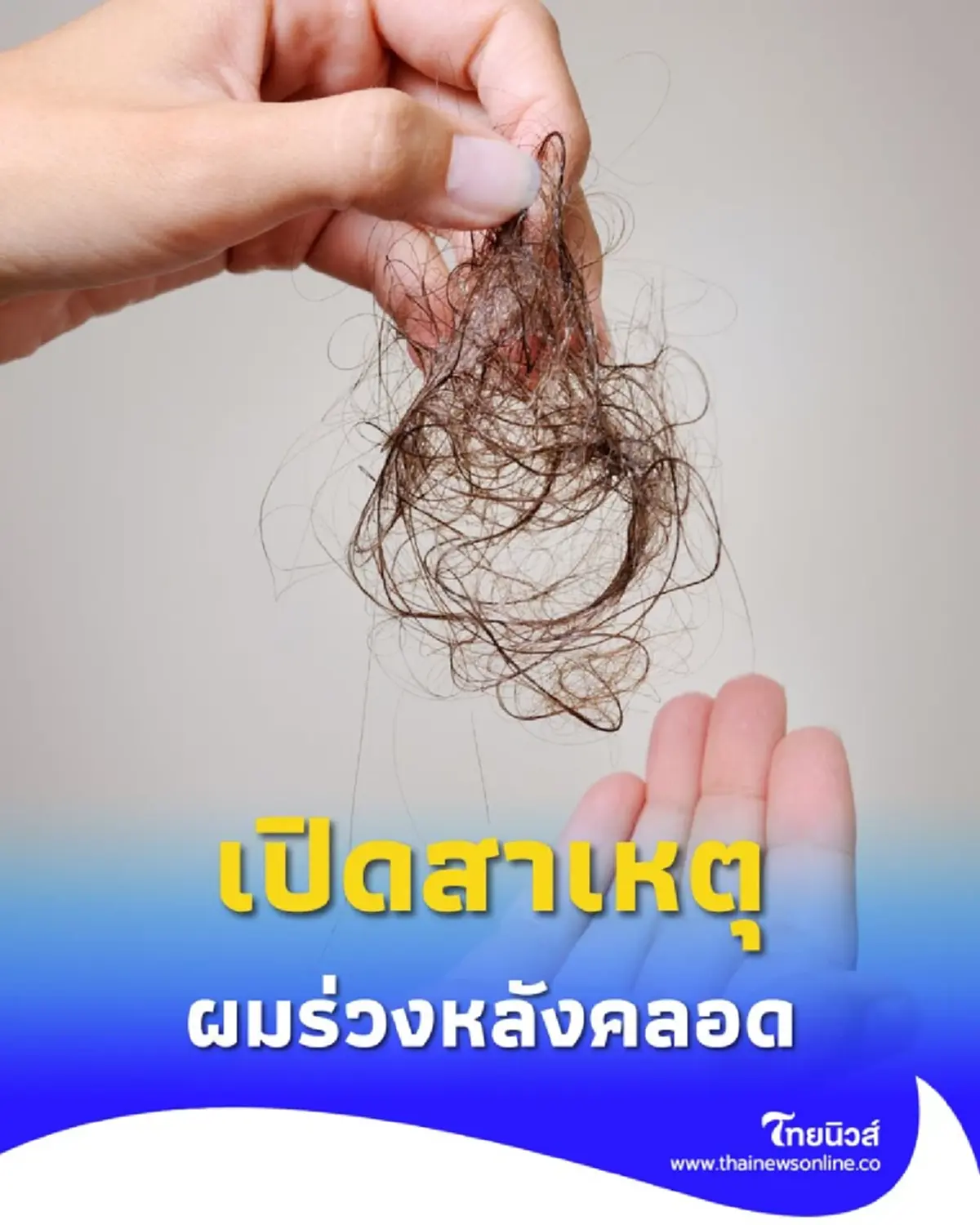 เปิดสาเหตุภาวะ ผมร่วงหลังคลอด พร้อม 4 เคล็ดลับกู้ผมหนาคืนมา