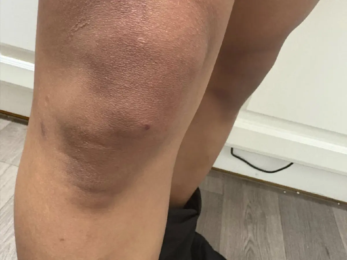 คนไทยในอังกฤษ เล่านาทีชีวิต ถูกผลักให้รถบัสชน แจ้งตำรวจยังเงียบ