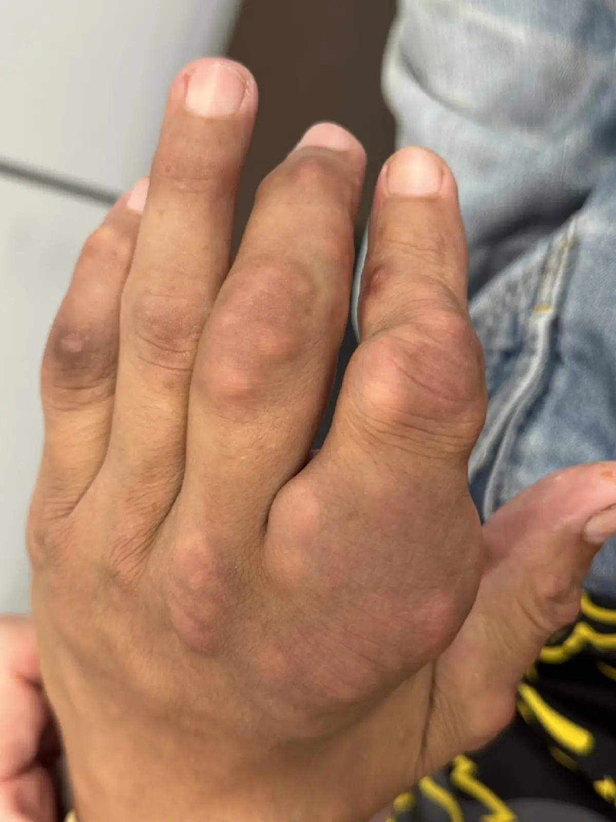 ปวดข้อ สู่ก้อนแข็งใต้ผิว หมอไขปริศนา "โทฟัส" ภัยเงียบโรคเก๊าท์